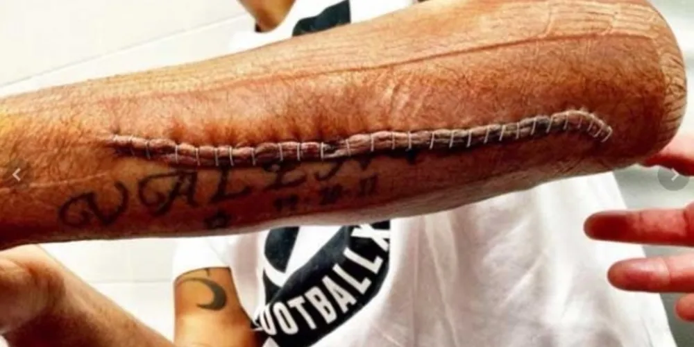 Imagem ilustrativa da imagem Ex-jogador da seleção fica com cicatriz enorme após contusão