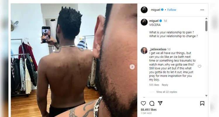O cantor usou as redes sociais para mostrar os ferimentos nas suas costas após o show