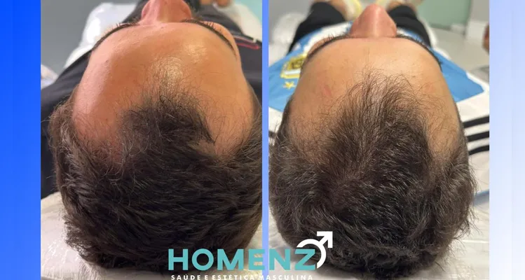 Campanha de Dia dos Pais da Homenz oferece preço especial para tratar calvície