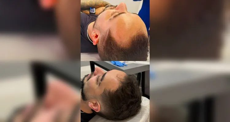 Dia dos Pais: Homenz oferece preço especial para tratar calvície