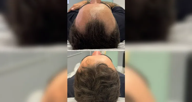 Dia dos Pais: Homenz oferece preço especial para tratar calvície