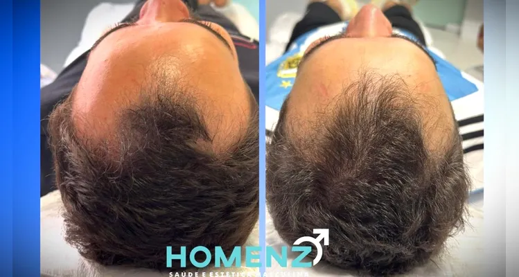 Clínica Homenz prepara promoção especial para tratamento de calvície