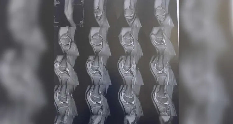 Família cria vaquinha online para auxiliar em cirurgia de adolescente de Ponta Grossa