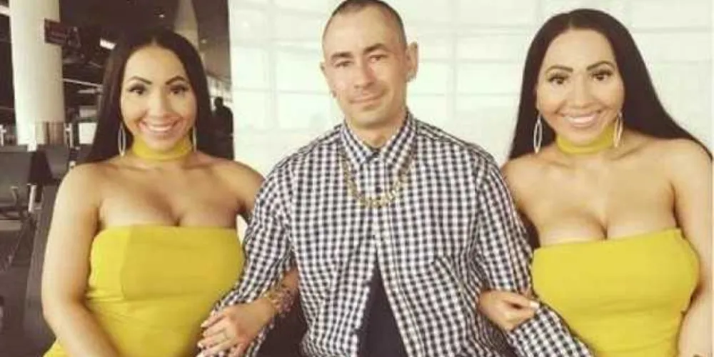 Imagem ilustrativa da imagem Gêmeas que ‘dividem’ marido se arrependem de cirurgias