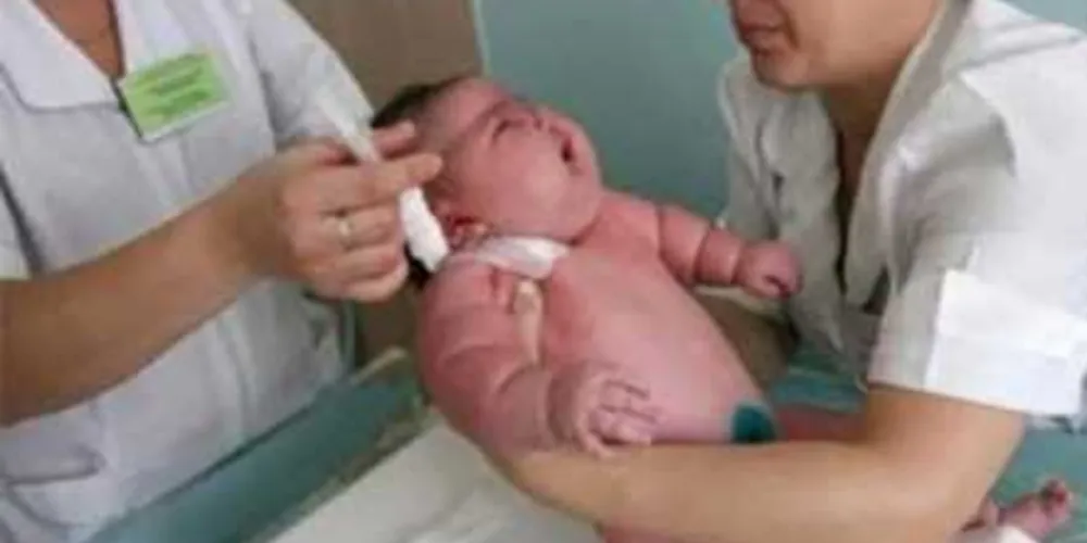 Imagem ilustrativa da imagem Bebê nasce com 18 kg e bate o recorde