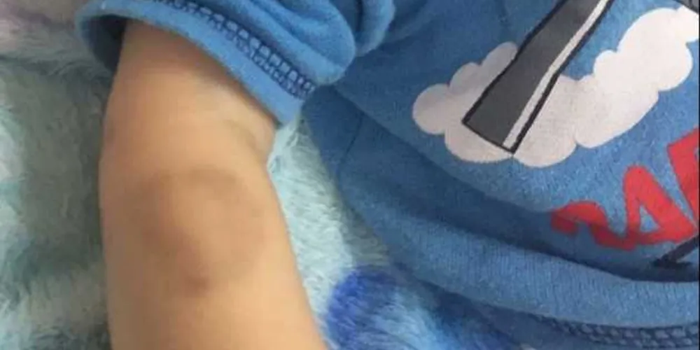 Entre as várias lesões, marca de mordida em braço da criança causa repulsa