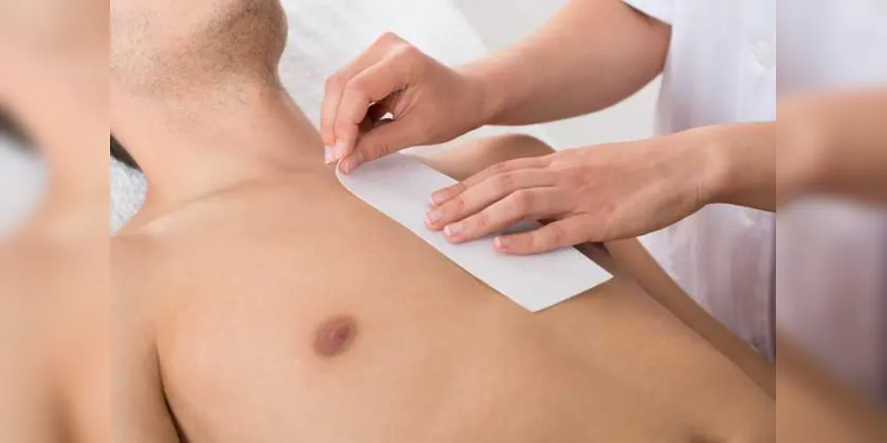 O tratamento é mais eficiente quando o pelo for grosso e bem preto, por conta da afinidade do aparelho pelo pigmento/Foto: Reprodução