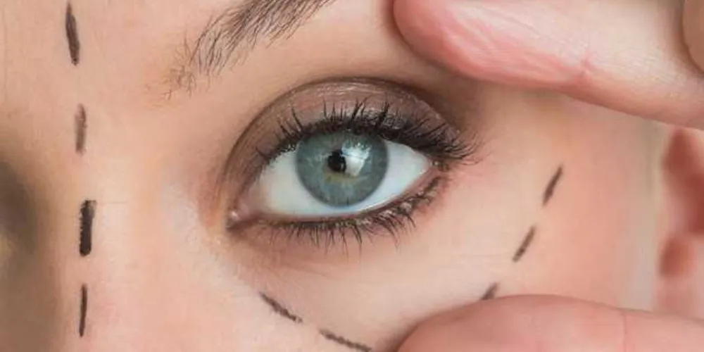 De acordo com cirurgiã, a procura pela blefaroplastia, como é conhecido o procedimento, não se limita a pessoas com mais de 30 anos