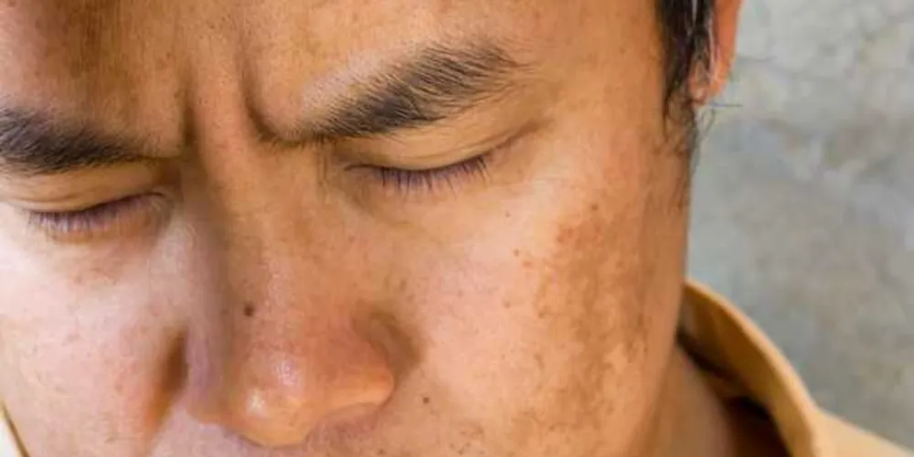 Apesar da incidência ser maior em mulheres, casos podem ocorrer em homens/Foto: Reprodução 