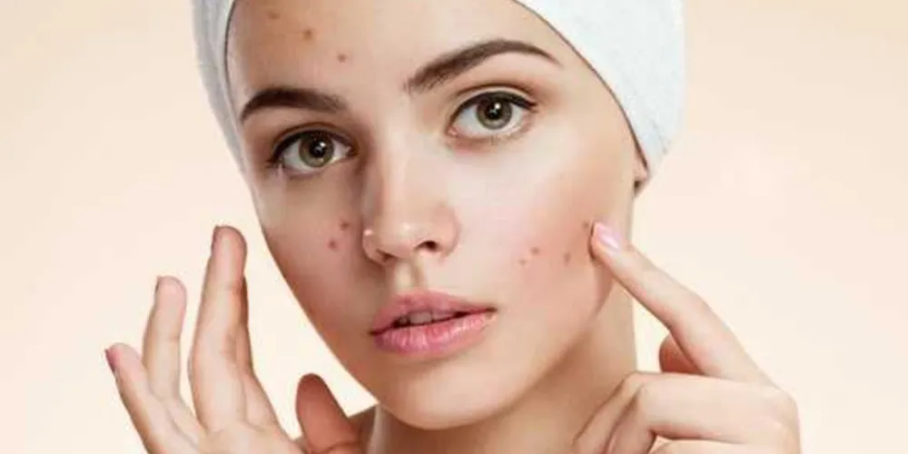 Imagem ilustrativa da imagem Sofre com acne? Dermatologista esclarece dúvidas mais comuns