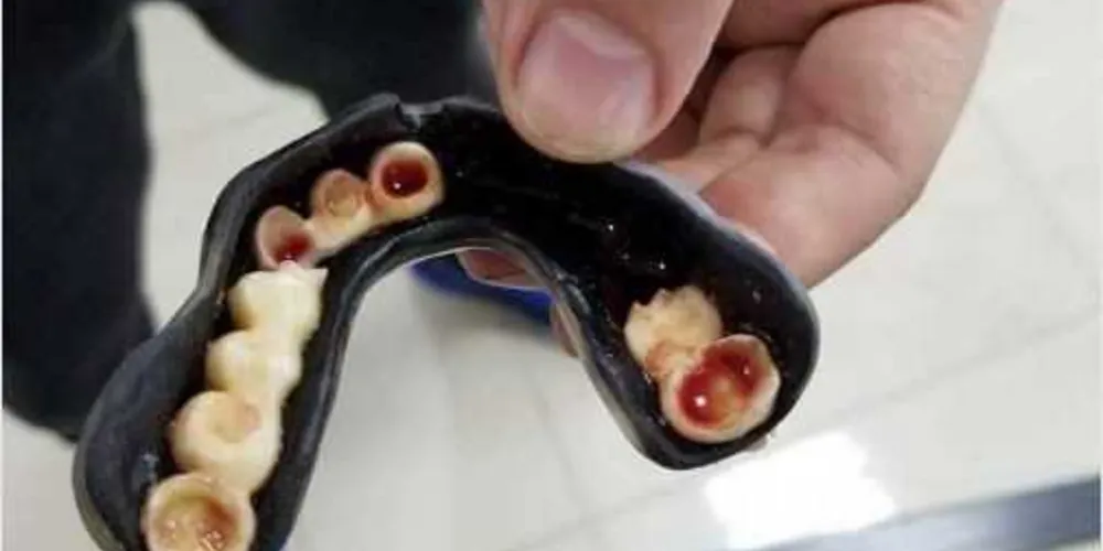 Um lutador perdeu os dentes, literalmente, durante uma recente luta de MMA na China