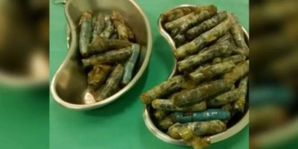 Imagem ilustrativa da imagem Preso faz cirurgia para retirar maconha do estômago em Francisco Beltrão