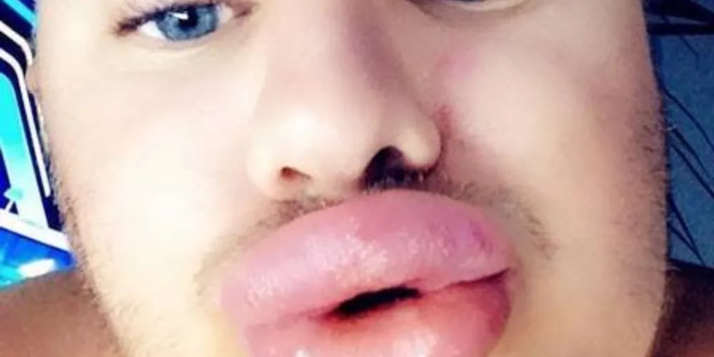 Cyril Roux, de 32 anos após a cirurgia plástica./Foto: Reprodução Twitter(teiifttomas - @Islandia35Tomas