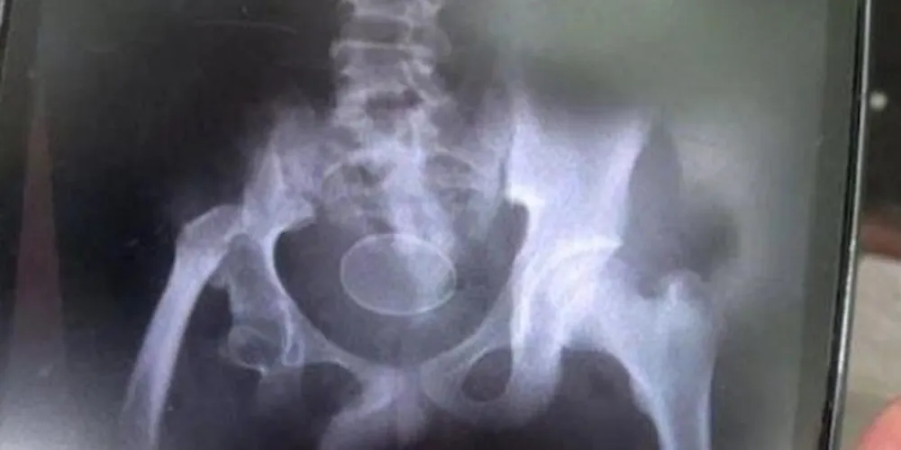 Os médicos estão trabalhando para identificar quem foi o responsável por inserir os ovos no corpo do adolescente/Foto: Reprodução Daily Mail