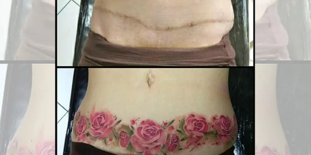 Imagem ilustrativa da imagem Cicatrizes cirúrgicas podem ser cobertas por tatuagens