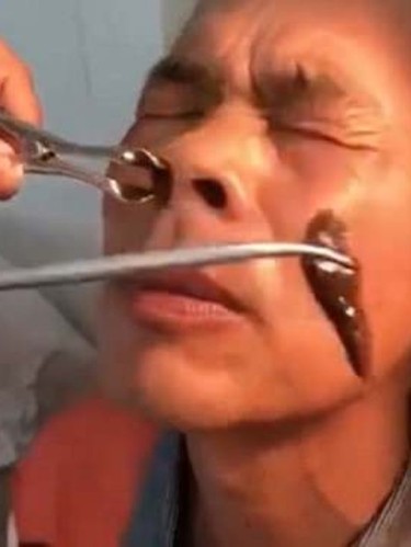 Após sentir uma movimentação estranha dentro de seu nariz, o chinês decidiu procurar ajuda em um hospital, onde a sanguessuga foi descoberta / Foto Reprodução Daily Mail