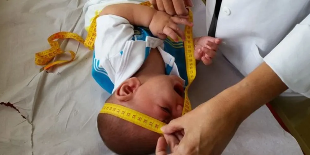 Bebê com microcefalia