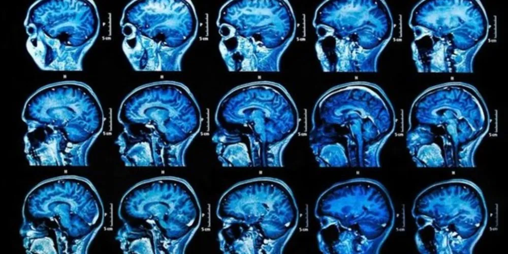 Imagem ilustrativa da imagem A possível e surpreendente causa para o Alzheimer