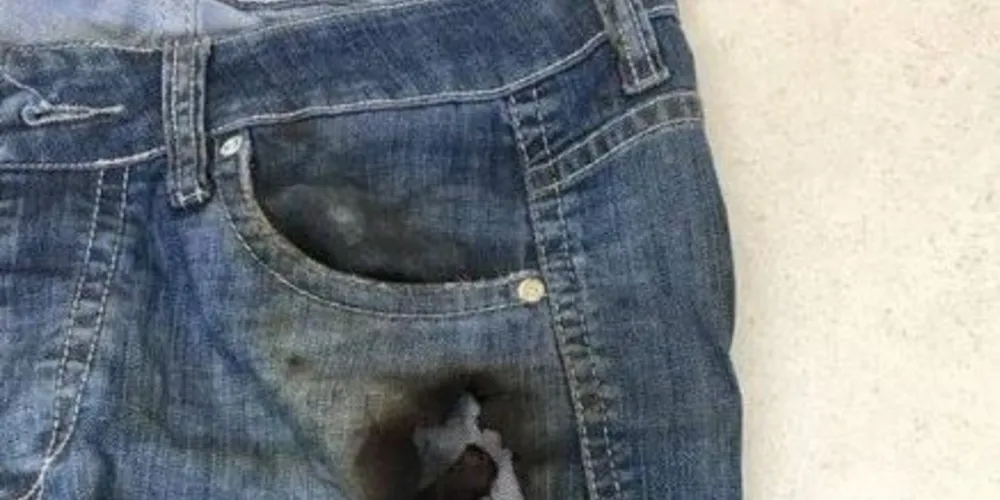 Ele sofreu queimaduras na perna esquerda e nos dedos das mãos 