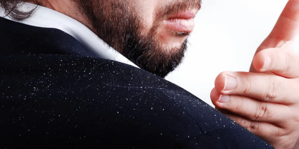 Imagem ilustrativa da imagem Cabelo masculino sem queda e sem caspa: como conseguir?