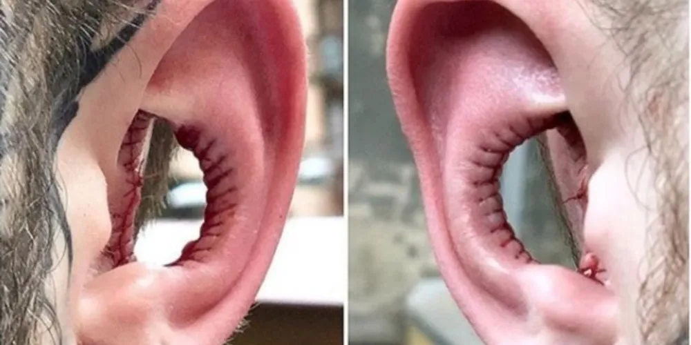 Foto foi postada pelo especialista em body modification Chai Maibert