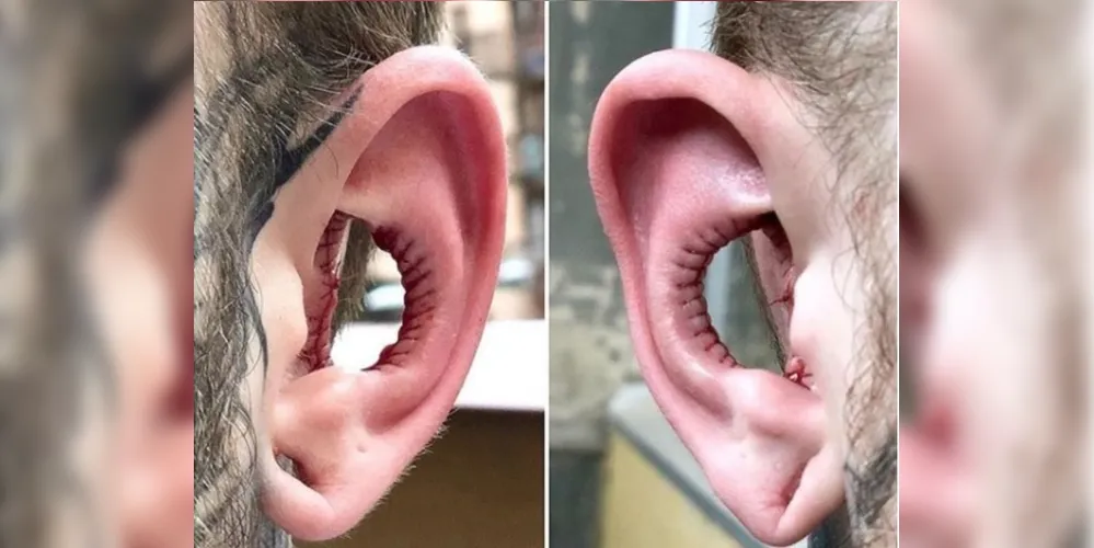 Foto foi postada pelo especialista em body modification Chai Maibert