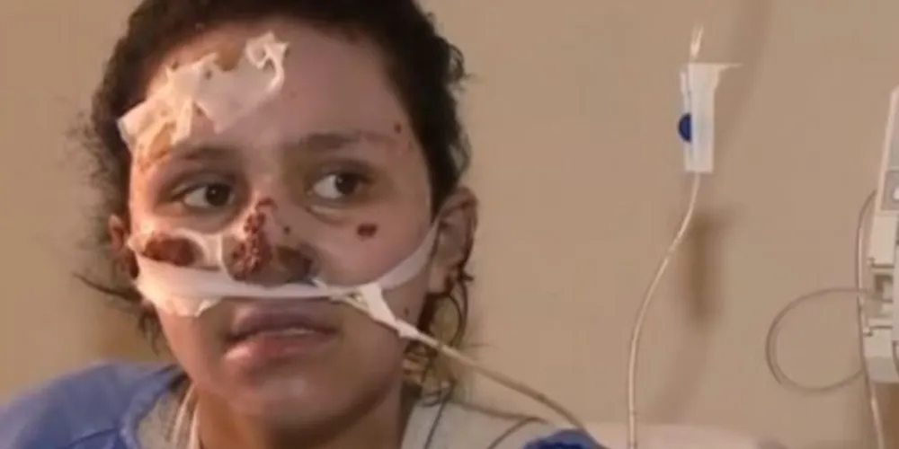 Menina que salvou irmão de incêndio morre no hospital