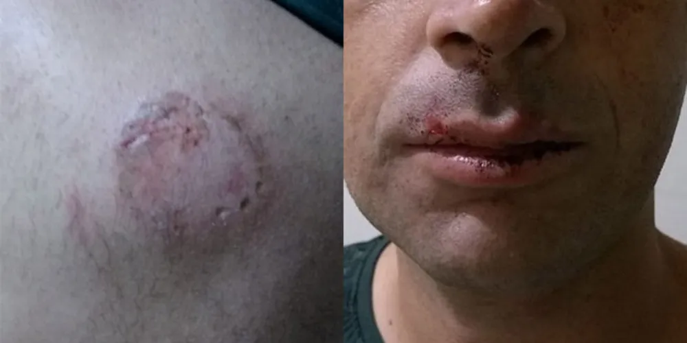 Além da mordida nas costas, taxista também sofreu lesões na boca e no nariz por causa das agressões