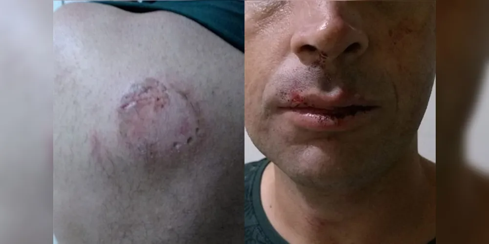 Além da mordida nas costas, taxista também sofreu lesões na boca e no nariz por causa das agressões