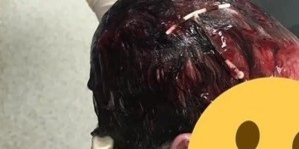 Em sua publicação no Facebook, Cadesia Foster comparou o DIU na cabeça do filho a um grampo de cabelo