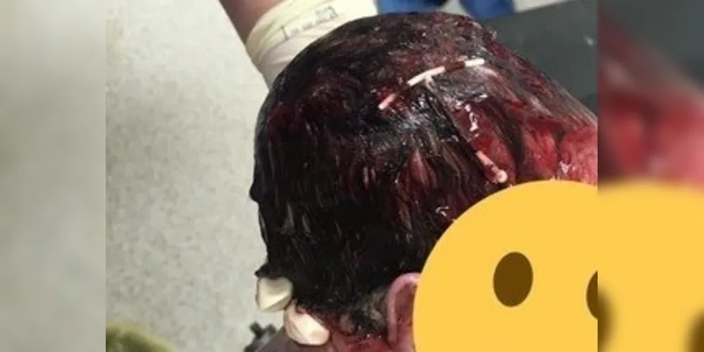 Em sua publicação no Facebook, Cadesia Foster comparou o DIU na cabeça do filho a um grampo de cabelo