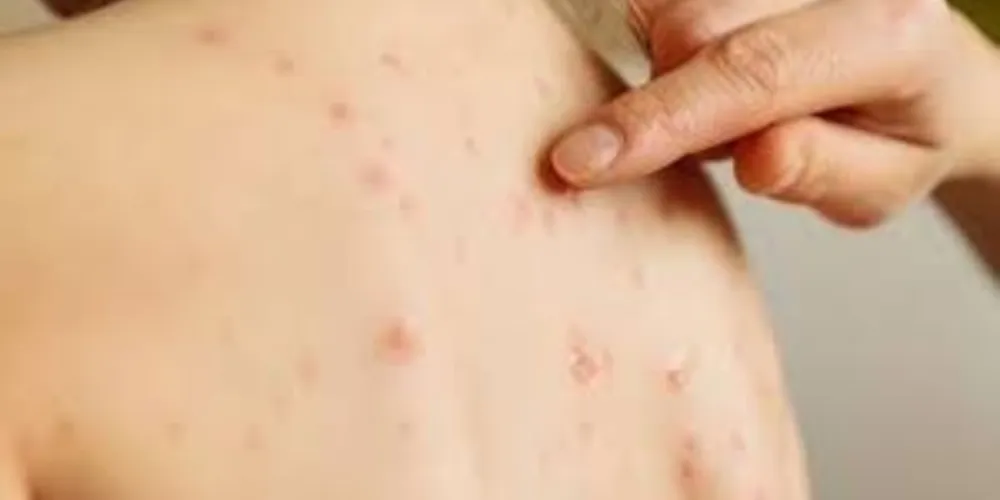 Mais de 100 pessoas no Paraná tiveram ou estão com sarampo. 