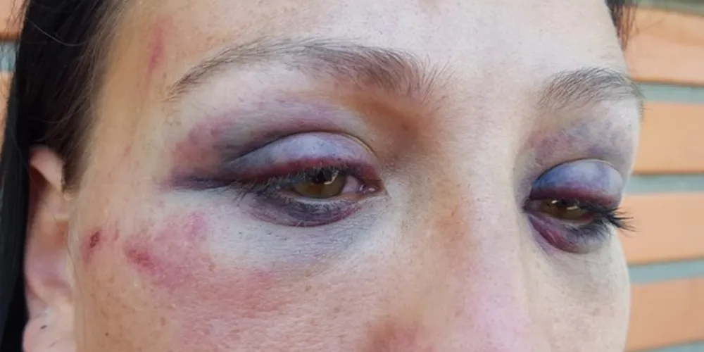 Hematomas causados pelas agressões do rapaz à vítima