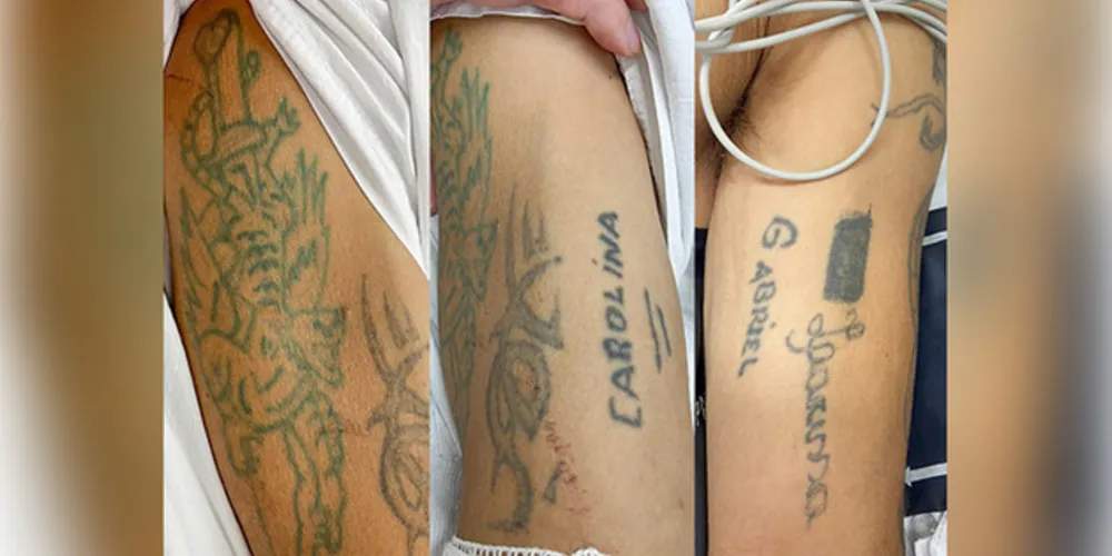 Paciente tem tatuagens nos dois braços, cerca de 40 anos de idade e não portava documentos