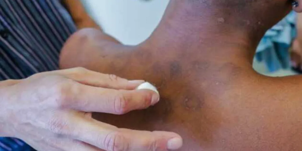 A hanseníase afeta a pele e os nervos. Ela gera a perda de sensibilidade do portador, inclusive reduzindo a percepção do calor nas partes afetadas. 