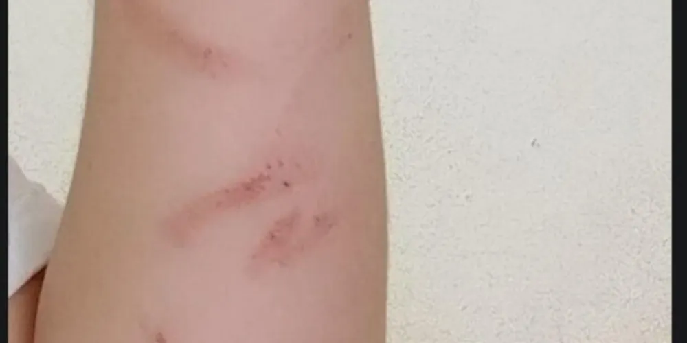 Motorista ficou com marcas pelo corpo