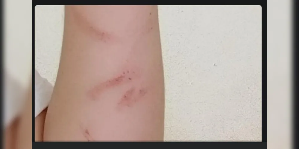 Motorista ficou com marcas pelo corpo