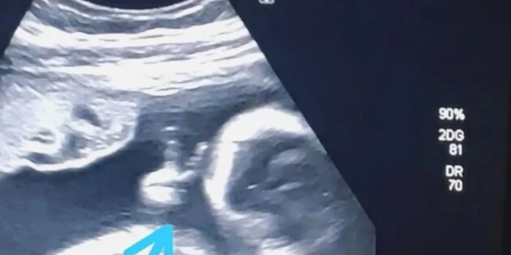 o bebê fez um ‘V de vitória’ com a mãozinha, dentro do útero