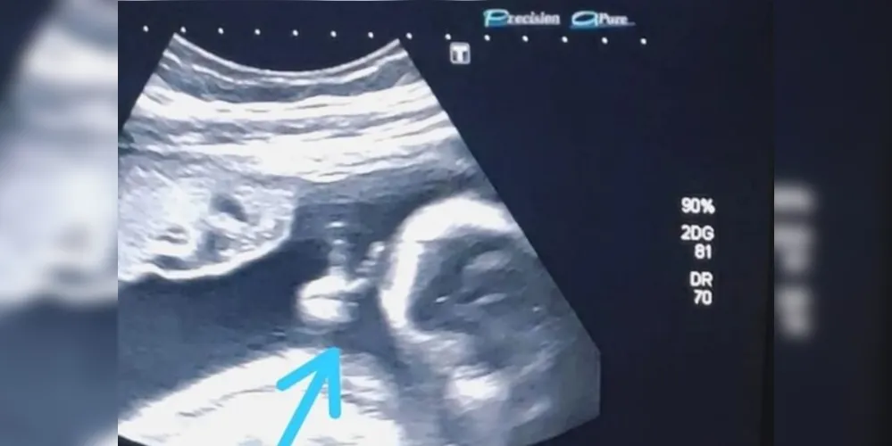 o bebê fez um ‘V de vitória’ com a mãozinha, dentro do útero