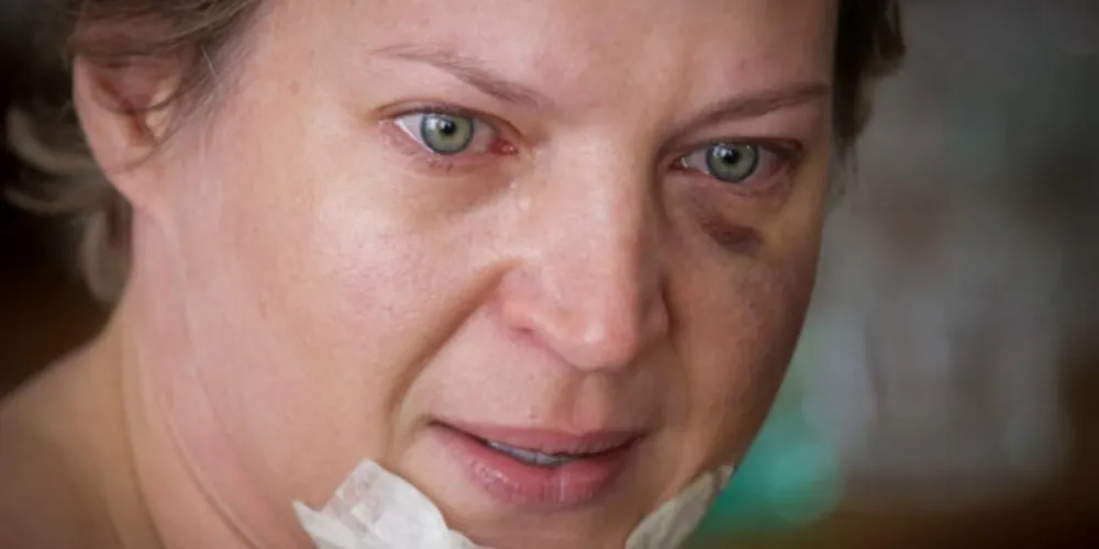 Deputado federal Joice Hasselmann (PSL) com ferimentos no rosto.