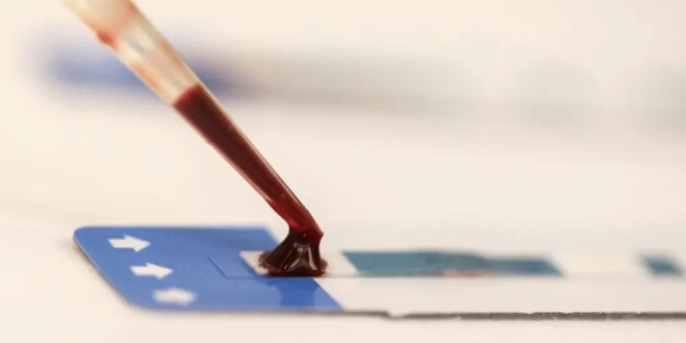 Em laboratório, técnica desenvolvida pelo Instituto de Física de São Carlos conseguiu combater o vírus HIV