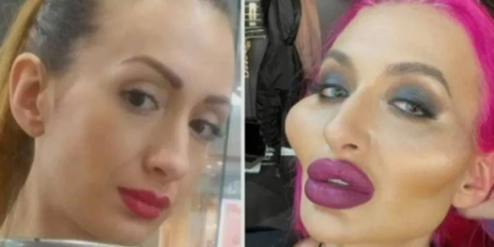 Anastasia Pokreshchuk, de 32 anos, ficou famosa no mundo todo após fazer repetidos procedimentos