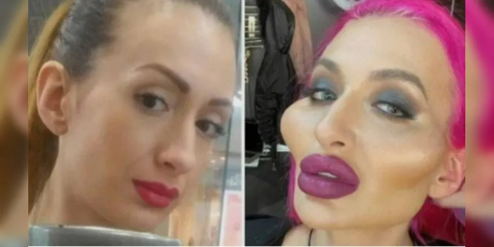 Anastasia Pokreshchuk, de 32 anos, ficou famosa no mundo todo após fazer repetidos procedimentos