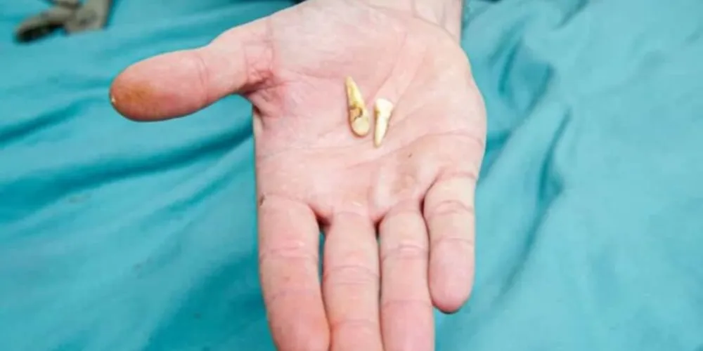 Mulher de 34 anos ficou indignada com o fim do relacionamento, dopou o ex-namorado e realizou as extrações