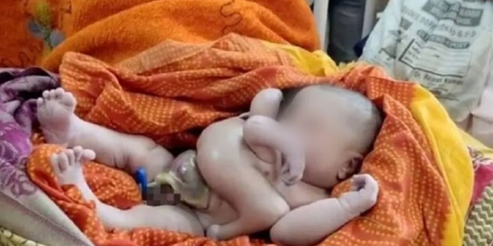 Condição do recém-nascido atraiu olhares de religiosos, que acreditam ser a reencarnação de um deus hindu