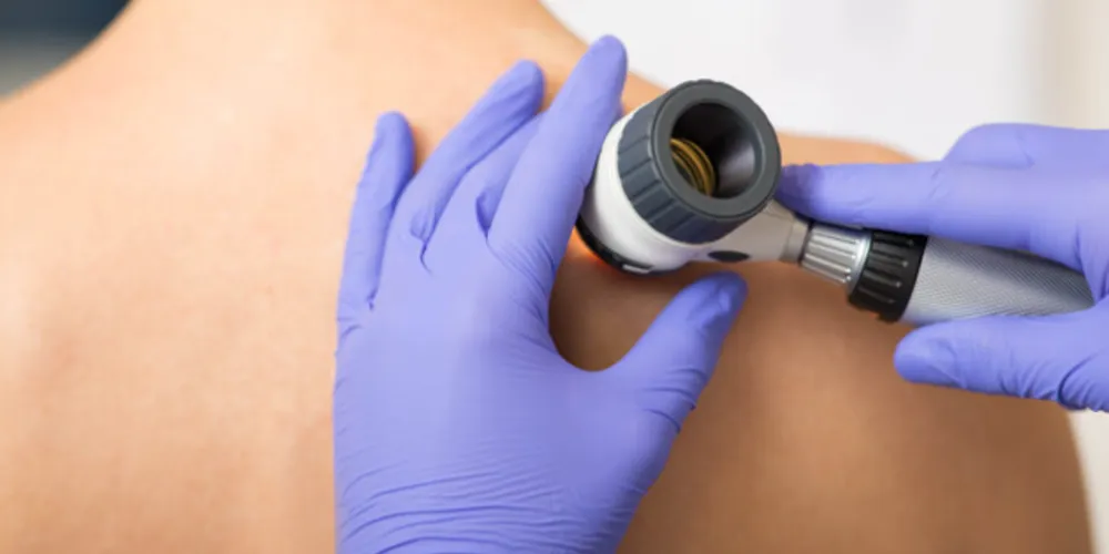 Embora as pintas sejam preocupantes, cirurgião oncológico do Hospital São Vicente explica que a maioria dos cânceres de pele se apresenta como lesões avermelhadas