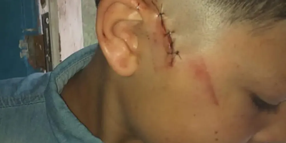 A criança teve a audição comprometida e está se alimentando com dificuldades.