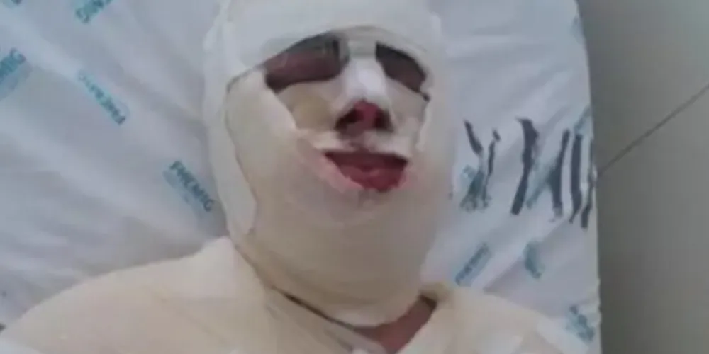 A vítima teve queimaduras no rosto, no ombro e no peito; o suspeito deverá responder por tentativa de homicídio, ameaça, coação de testemunha, estelionato e dano