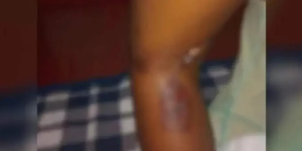A mãe teria esquentado uma colher no fogo e encostou na pele da criança.