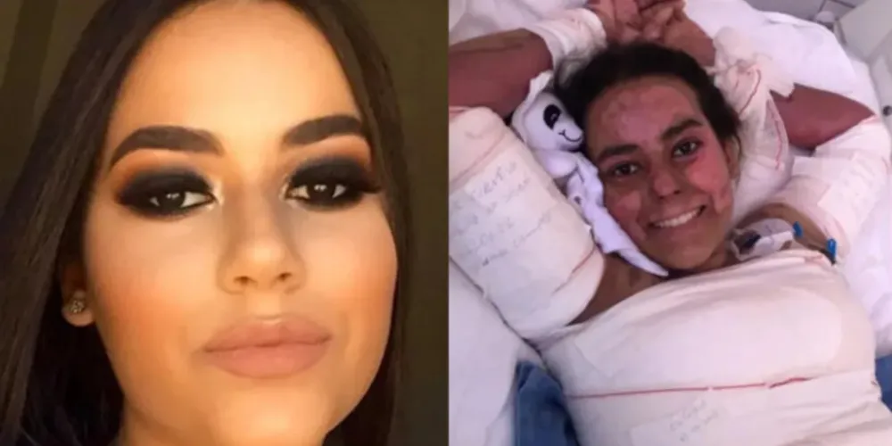 A estudante Annelise Lopes Andrade, de 16 anos, internada em Goiânia com 60% do corpo queimado.